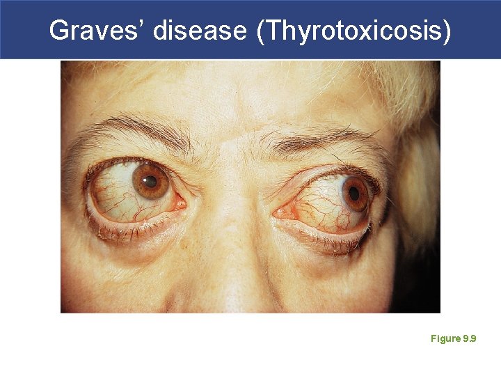 Graves’ disease (Thyrotoxicosis) Figure 9. 9 