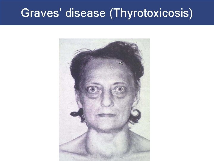 Graves’ disease (Thyrotoxicosis) 