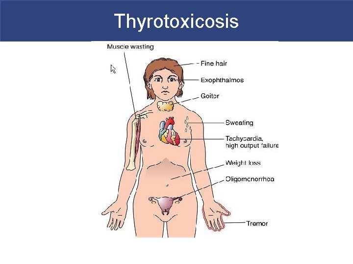 Thyrotoxicosis 