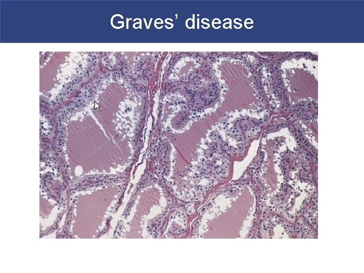 Graves’ disease 