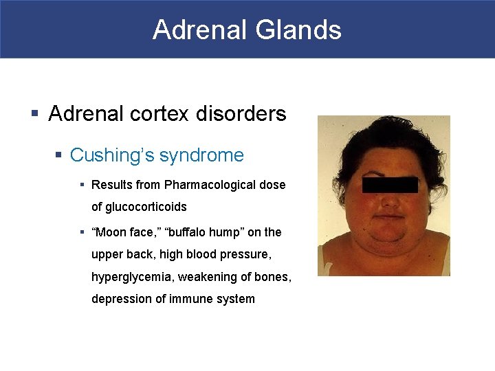 Adrenal Glands § Adrenal cortex disorders § Cushing’s syndrome § Results from Pharmacological dose
