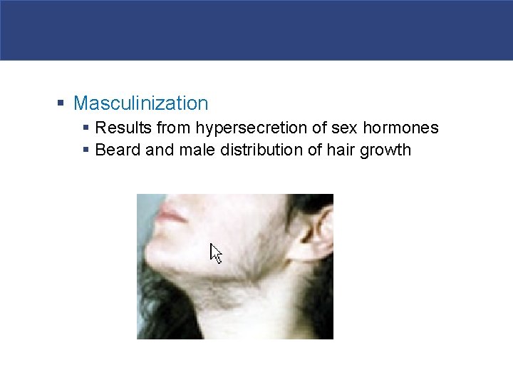 § Masculinization § Results from hypersecretion of sex hormones § Beard and male distribution