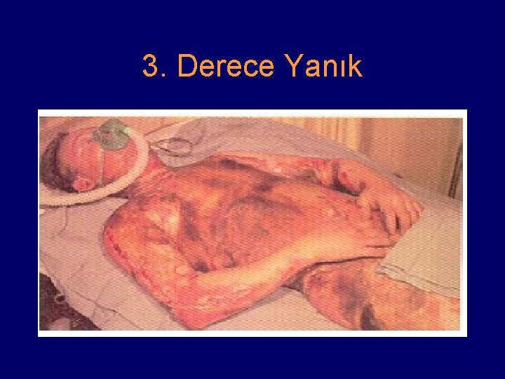 3. Derece Yanık 