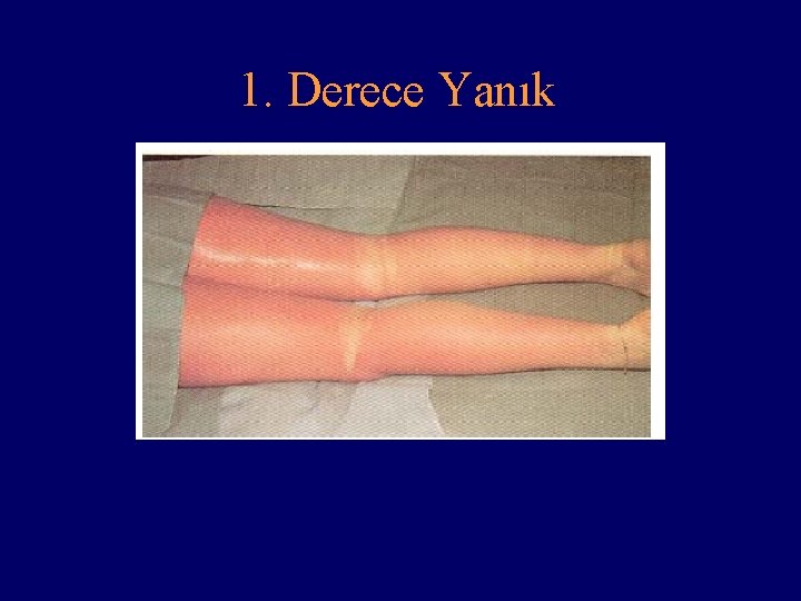 1. Derece Yanık 