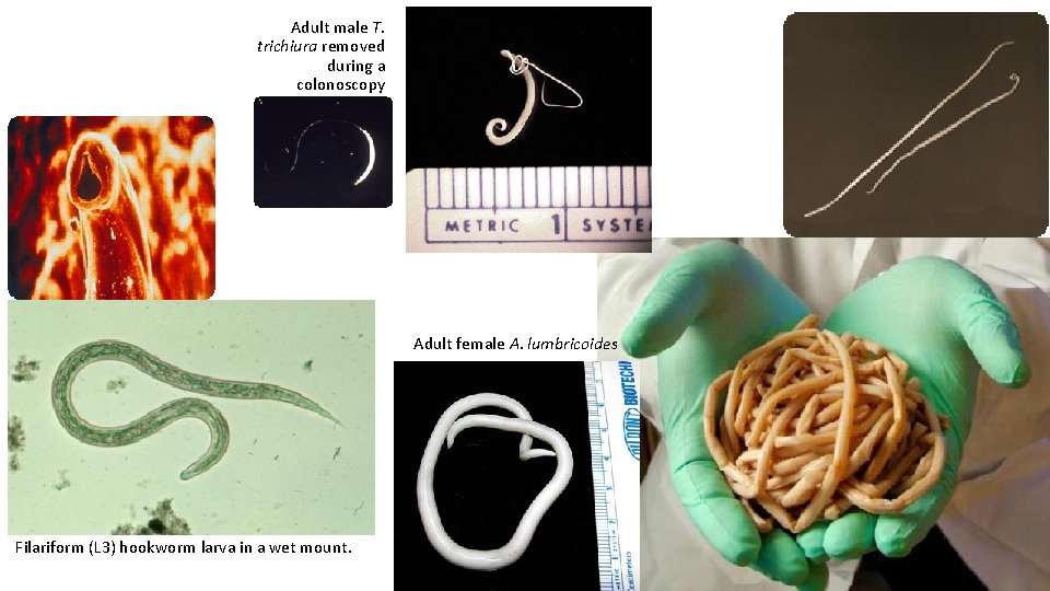 Adult male T. trichiura removed during a colonoscopy Adult female A. lumbricoides Filariform (L