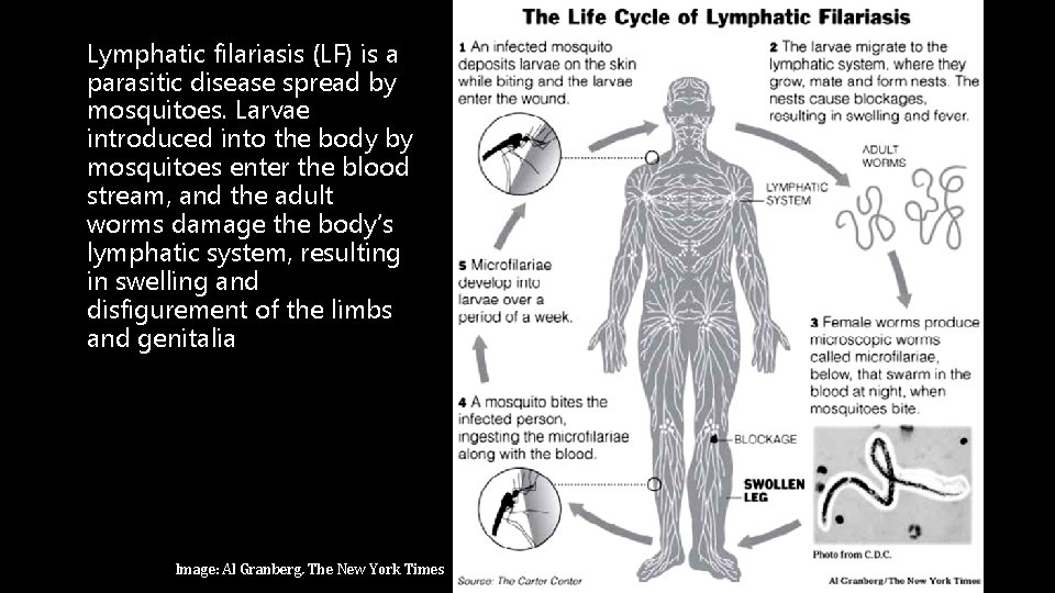 Lymphatic filariasis (LF) is a parasitic disease spread by mosquitoes. Larvae introduced into the