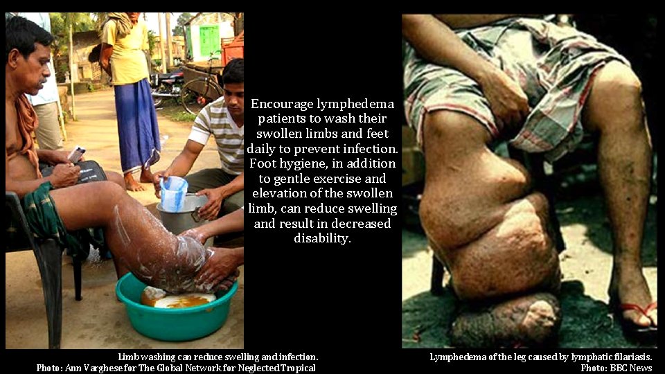 Encourage lymphedema patients to wash their swollen limbs and feet daily to prevent infection.