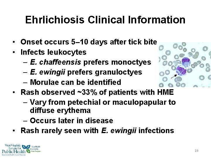 Ehrlichiosis Clinical Information • Onset occurs 5– 10 days after tick bite • Infects