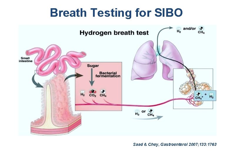 Breath Testing for SIBO Saad & Chey, Gastroenterol 2007; 133: 1763 