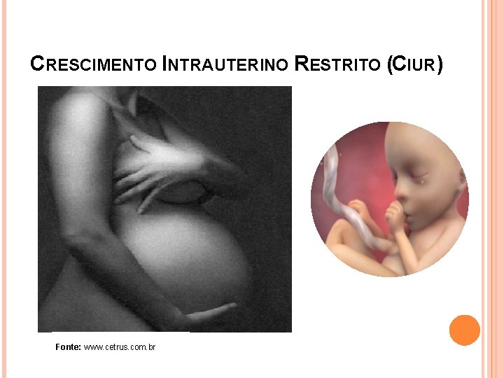 CRESCIMENTO INTRAUTERINO RESTRITO (CIUR) Fonte: www. cetrus. com. br 