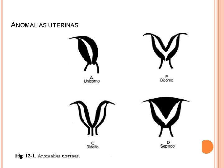 ANOMALIAS UTERINAS 