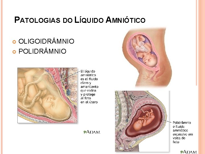 PATOLOGIAS DO LÍQUIDO AMNIÓTICO OLIGOIDR MNIO POLIDR MNIO 