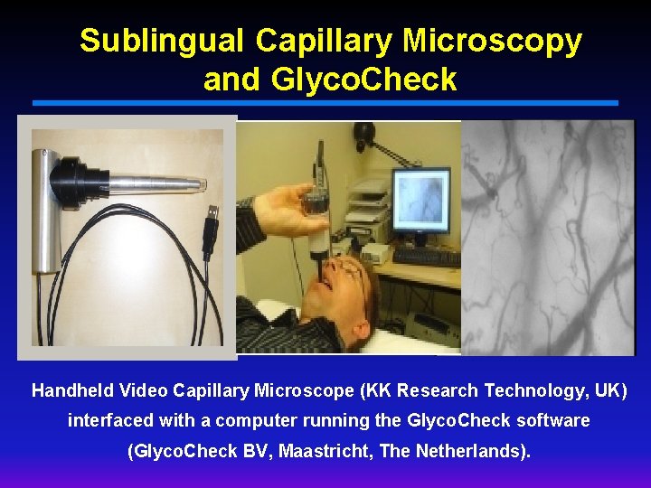 Sublingual Capillary Microscopy and Glyco. Check Handheld Video Capillary Microscope (KK Research Technology, UK)