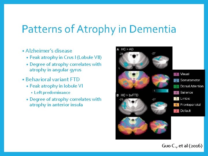 Patterns of Atrophy in Dementia • Alzheimer’s disease • Peak atrophy in Crus I