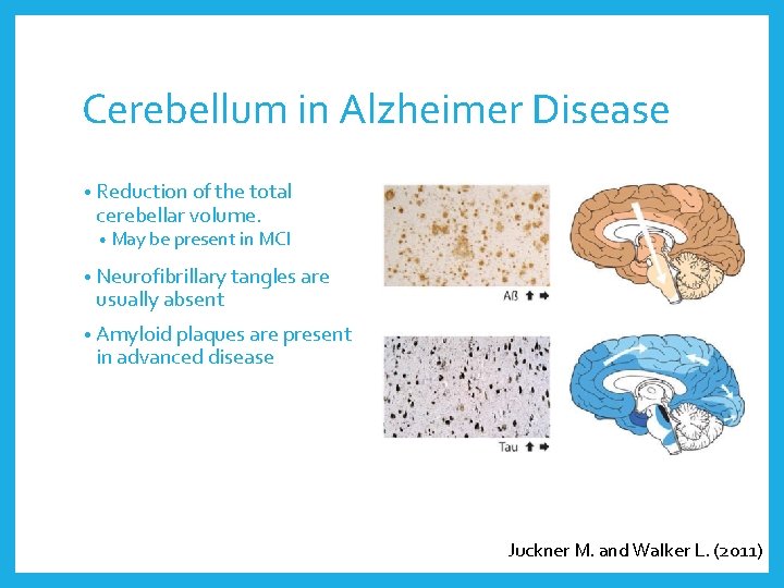 Cerebellum in Alzheimer Disease • Reduction of the total cerebellar volume. • May be