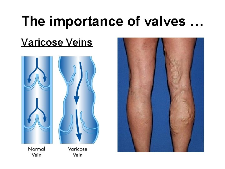 The importance of valves … Varicose Veins 