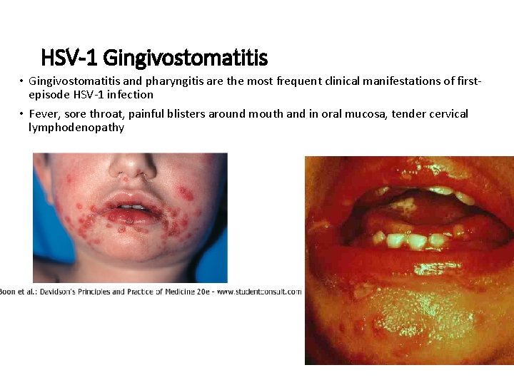 HSV-1 Gingivostomatitis • Gingivostomatitis and pharyngitis are the most frequent clinical manifestations of firstepisode