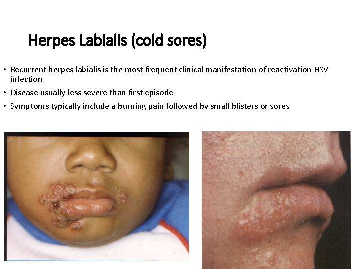 Herpes Labialis (cold sores) • Recurrent herpes labialis is the most frequent clinical manifestation