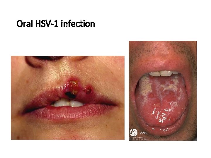 Oral HSV-1 infection 