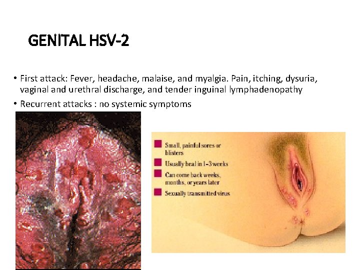 GENITAL HSV-2 • First attack: Fever, headache, malaise, and myalgia. Pain, itching, dysuria, vaginal