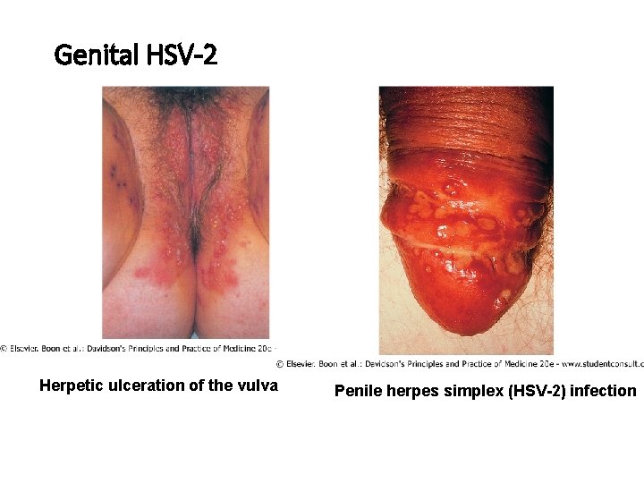 Genital HSV-2 Herpetic ulceration of the vulva Penile herpes simplex (HSV-2) infection 