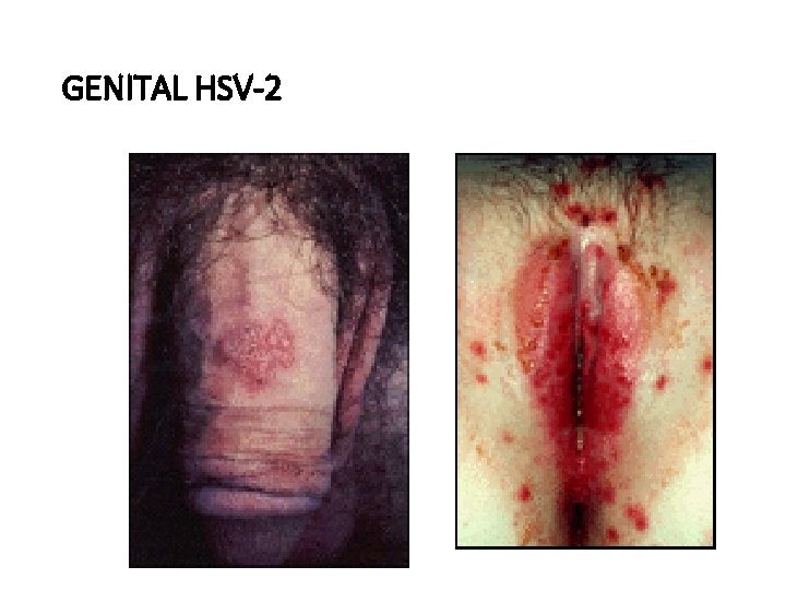 GENITAL HSV-2 