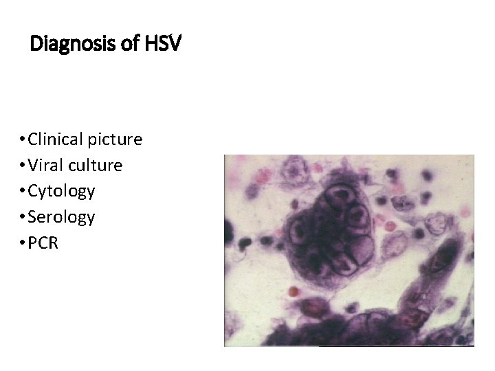 Diagnosis of HSV • Clinical picture • Viral culture • Cytology • Serology •