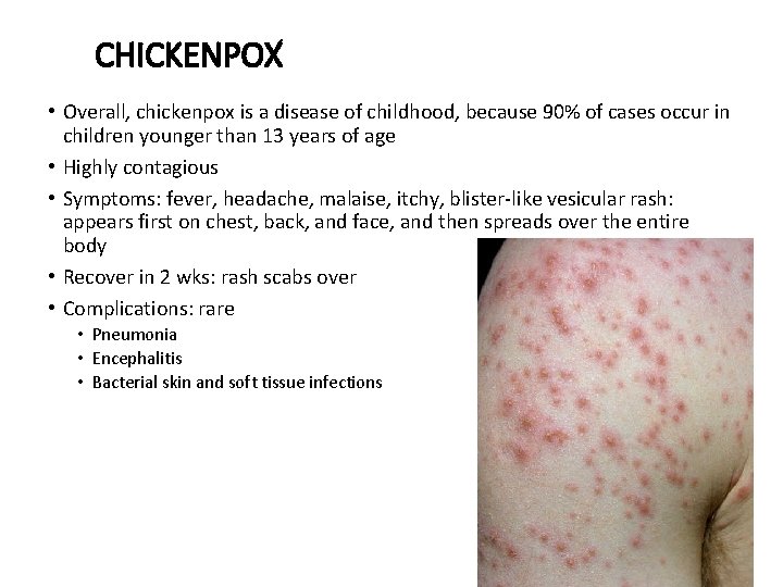 CHICKENPOX • Overall, chickenpox is a disease of childhood, because 90% of cases occur
