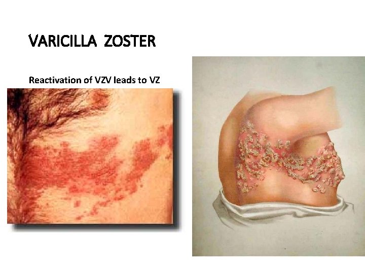 VARICILLA ZOSTER Reactivation of VZV leads to VZ 
