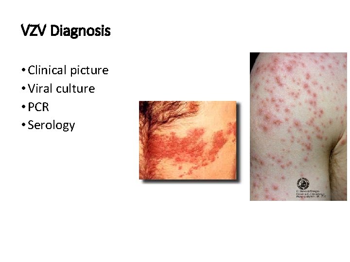 VZV Diagnosis • Clinical picture • Viral culture • PCR • Serology 