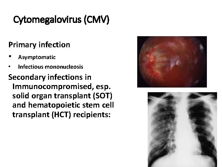 Cytomegalovirus (CMV) Primary infection • Asymptomatic • Infectious mononucleosis Secondary infections in Immunocompromised, esp.