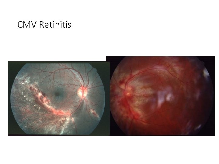 CMV Retinitis 
