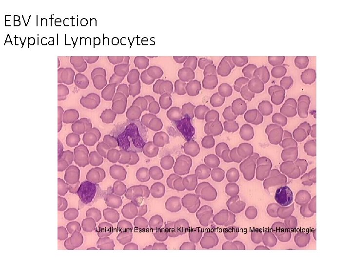 EBV Infection Atypical Lymphocytes 