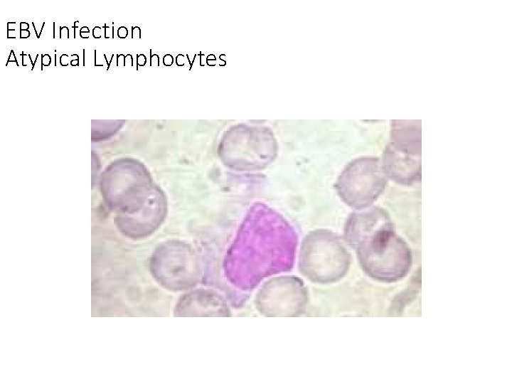 EBV Infection Atypical Lymphocytes 