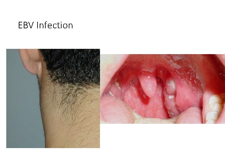 EBV Infection 