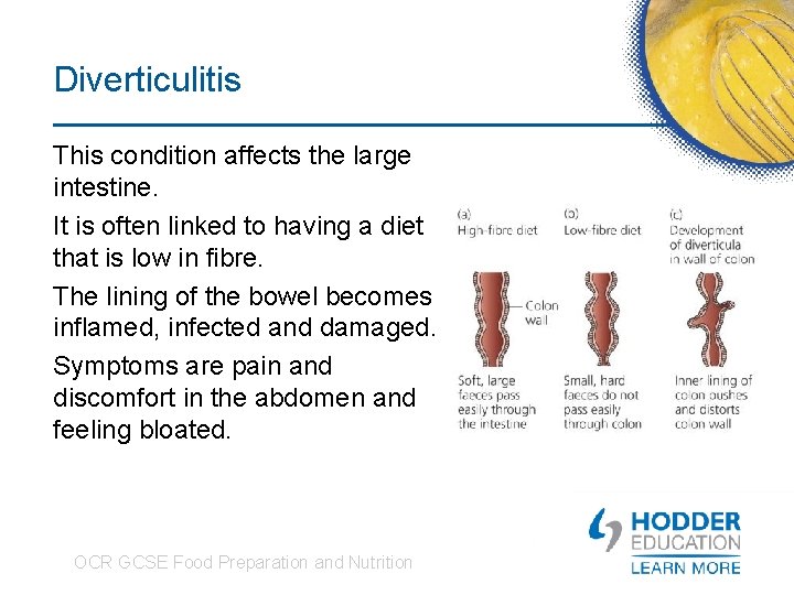 Diverticulitis This condition affects the large intestine. It is often linked to having a