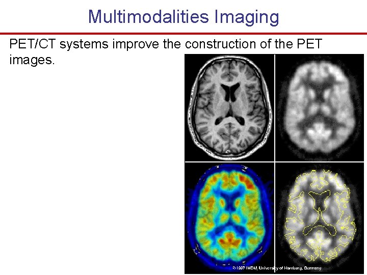 Multimodalities Imaging PET/CT systems improve the construction of the PET images. 