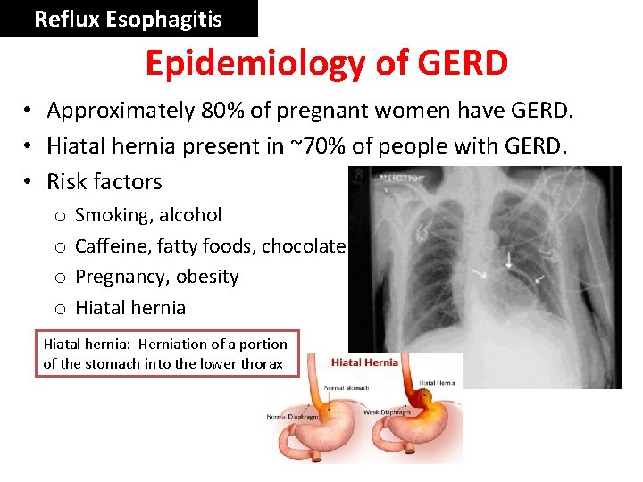 Reflux Esophagitis Epidemiology of GERD • Approximately 80% of pregnant women have GERD. •