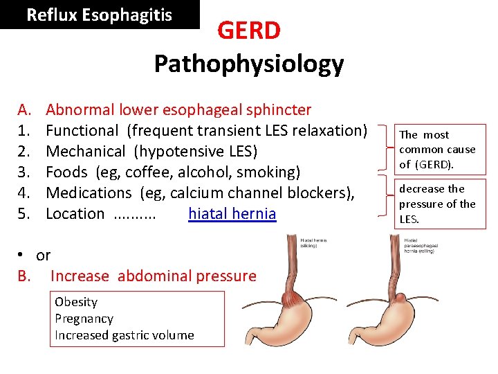 Reflux Esophagitis GERD Pathophysiology A. 1. 2. 3. 4. 5. Abnormal lower esophageal sphincter