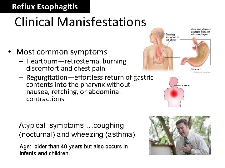 Reflux Esophagitis Clinical Manisfestations • Most common symptoms – Heartburn—retrosternal burning discomfort and chest