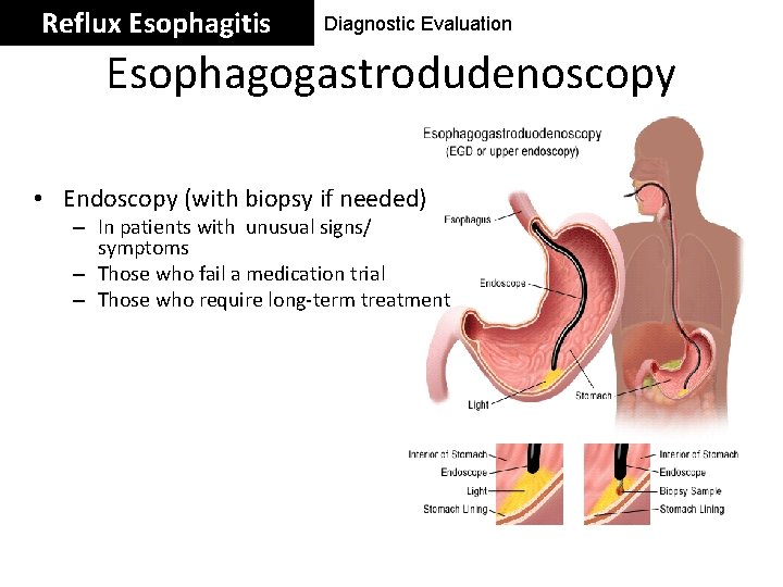 Reflux Esophagitis Diagnostic Evaluation Esophagogastrodudenoscopy • Endoscopy (with biopsy if needed) – In patients