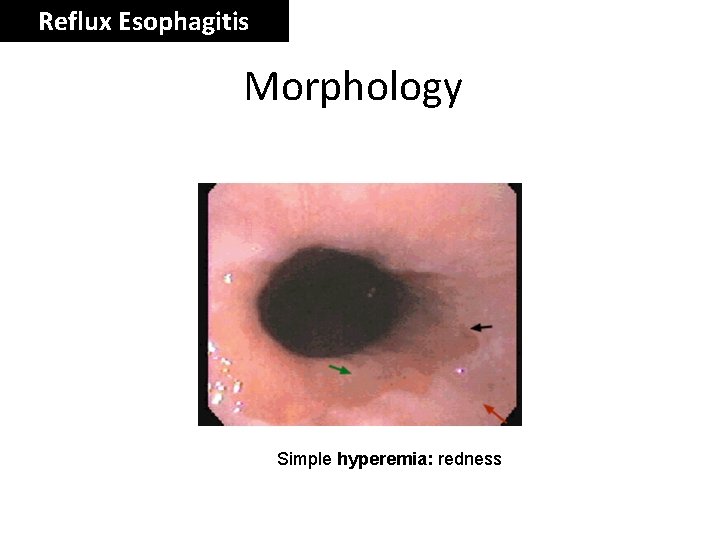 Reflux Esophagitis Morphology Simple hyperemia: redness 