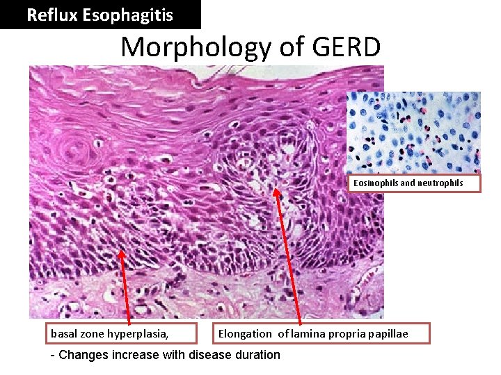 Reflux Esophagitis Morphology of GERD Eosinophils and neutrophils basal zone hyperplasia, Elongation of lamina