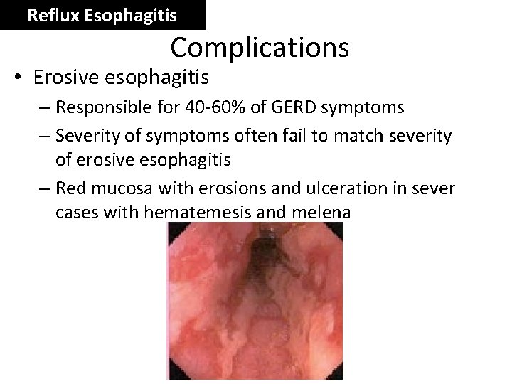 Reflux Esophagitis Complications • Erosive esophagitis – Responsible for 40 -60% of GERD symptoms
