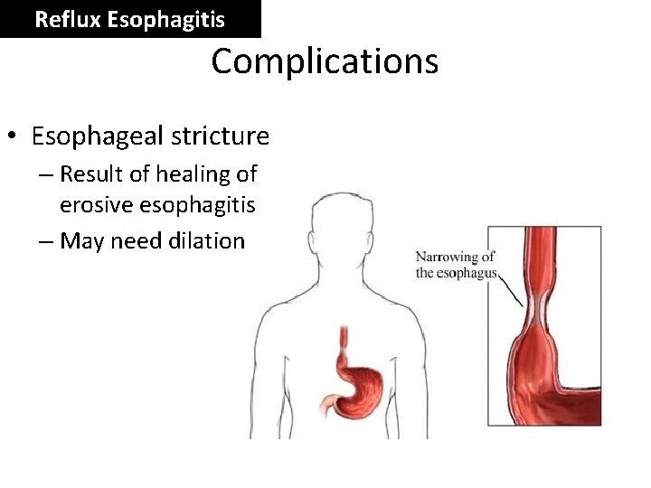 Reflux Esophagitis Complications • Esophageal stricture – Result of healing of erosive esophagitis –