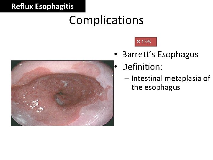 Reflux Esophagitis Complications 8 -15% • Barrett’s Esophagus • Definition: – Intestinal metaplasia of