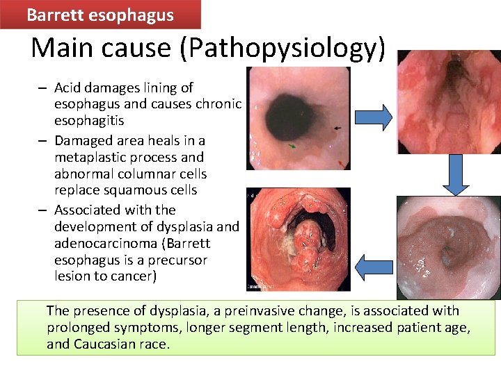 Barrett esophagus Main cause (Pathopysiology) – Acid damages lining of esophagus and causes chronic