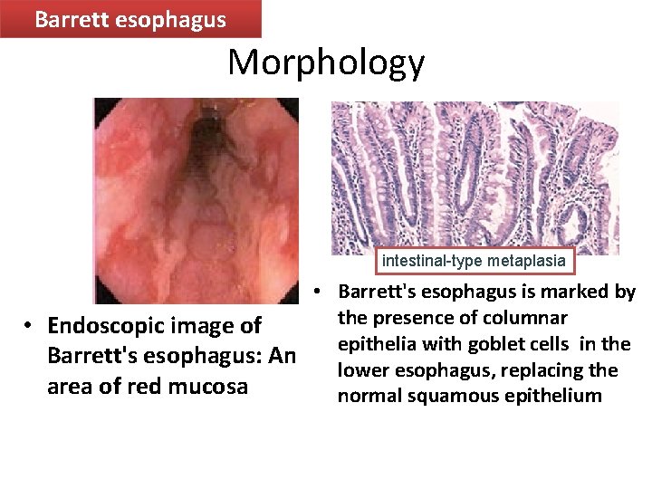 Barrett esophagus Morphology intestinal-type metaplasia • Barrett's esophagus is marked by the presence of