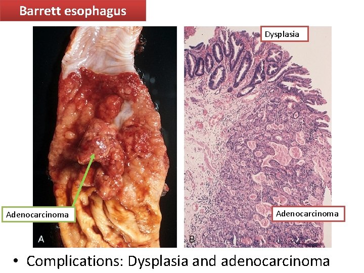 Barrett esophagus Dysplasia Adenocarcinoma • Complications: Dysplasia and adenocarcinoma 