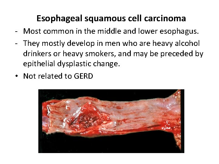 Esophageal squamous cell carcinoma - Most common in the middle and lower esophagus. -